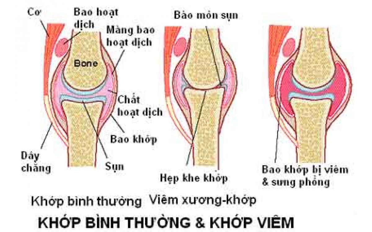 Những triệu chứng cảnh báo bệnh viêm khớp.