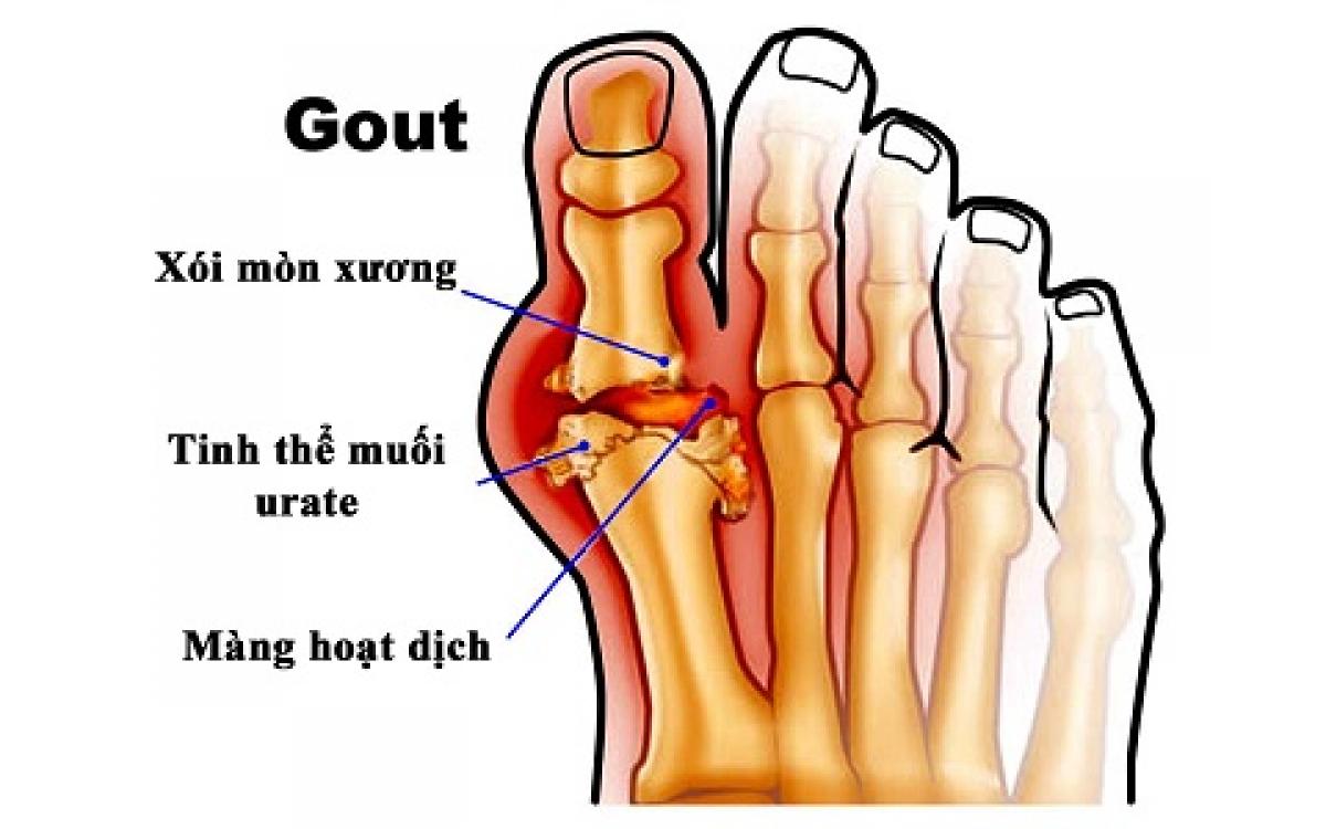 Dấu hiệu sớm nhận biết bệnh gút.